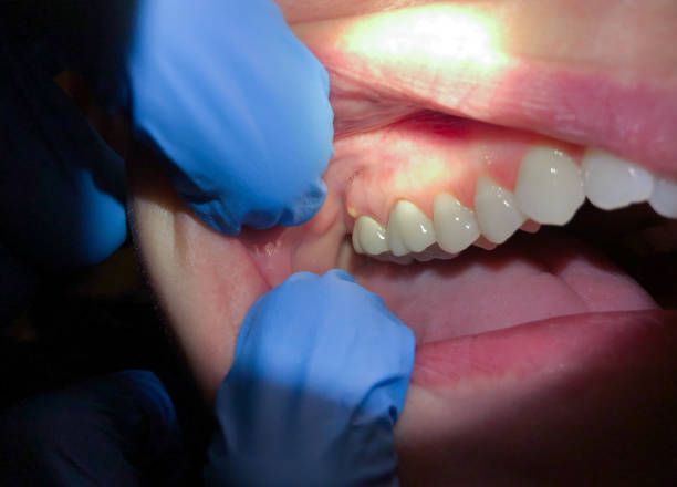 Best Tooth Infection Emergency Dentist  in Alachua, FL